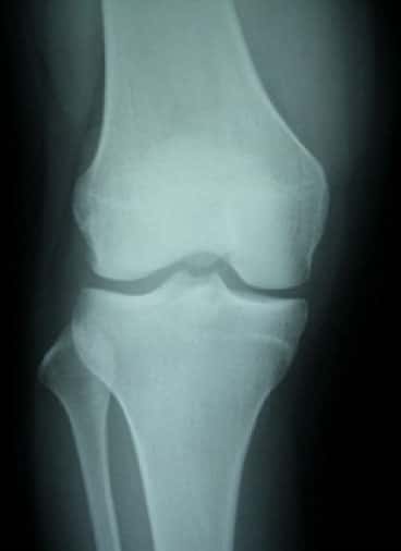 正常膝関節レントゲン