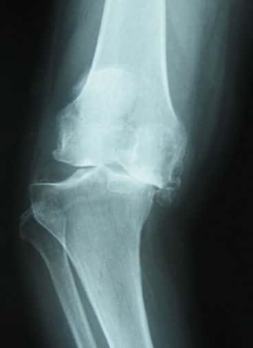 末期変形性膝関節症レントゲン